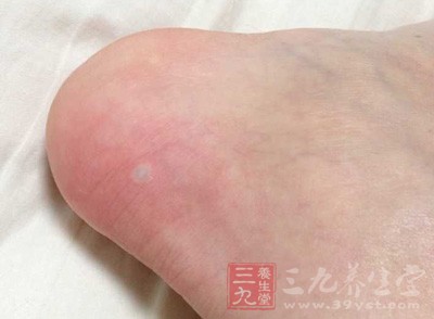 冻疮实际上就是冻伤