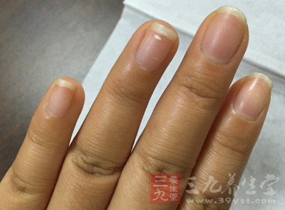 根治冻疮有很多小偏方